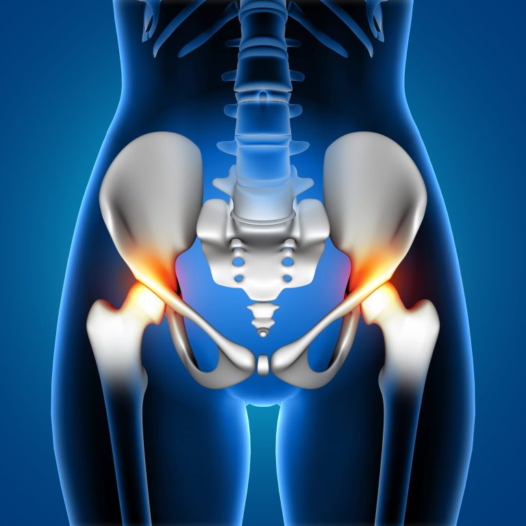 3D render of a medical female showing pain in hip joints