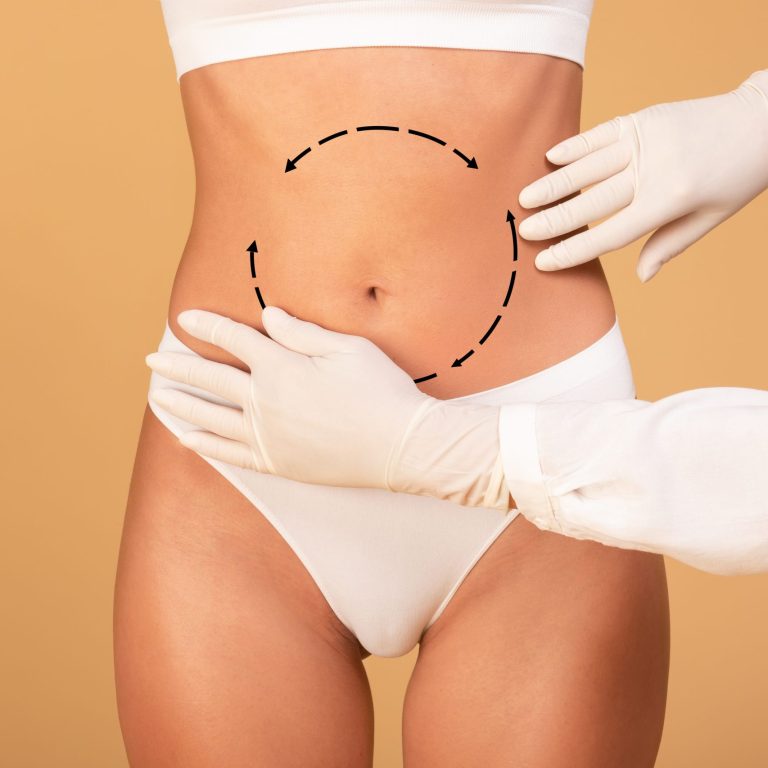 Beauty procedure for body. Slim lady having lipolysis treatment at beauty salon, cropped. Plastic surgeon making marks before surgery at belly area for woman