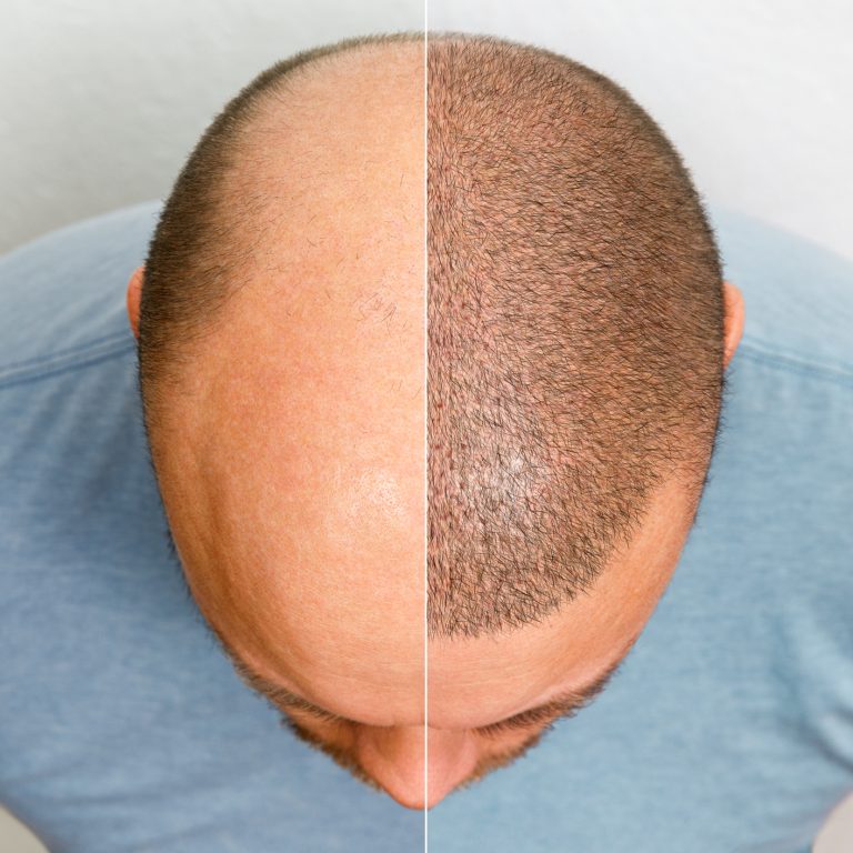 The head of a balding man before and after hair transplant surgery. A man losing his hair has become shaggy. An advertising poster for a hair transplant clinic. Treatment of baldness
