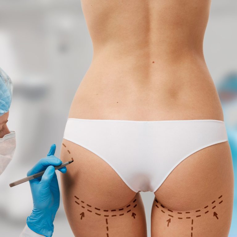 Drawing lines on a Caucasian woman's abdomen as marks for abdominal cellulite cosmetic correction surgery. Operation in the background